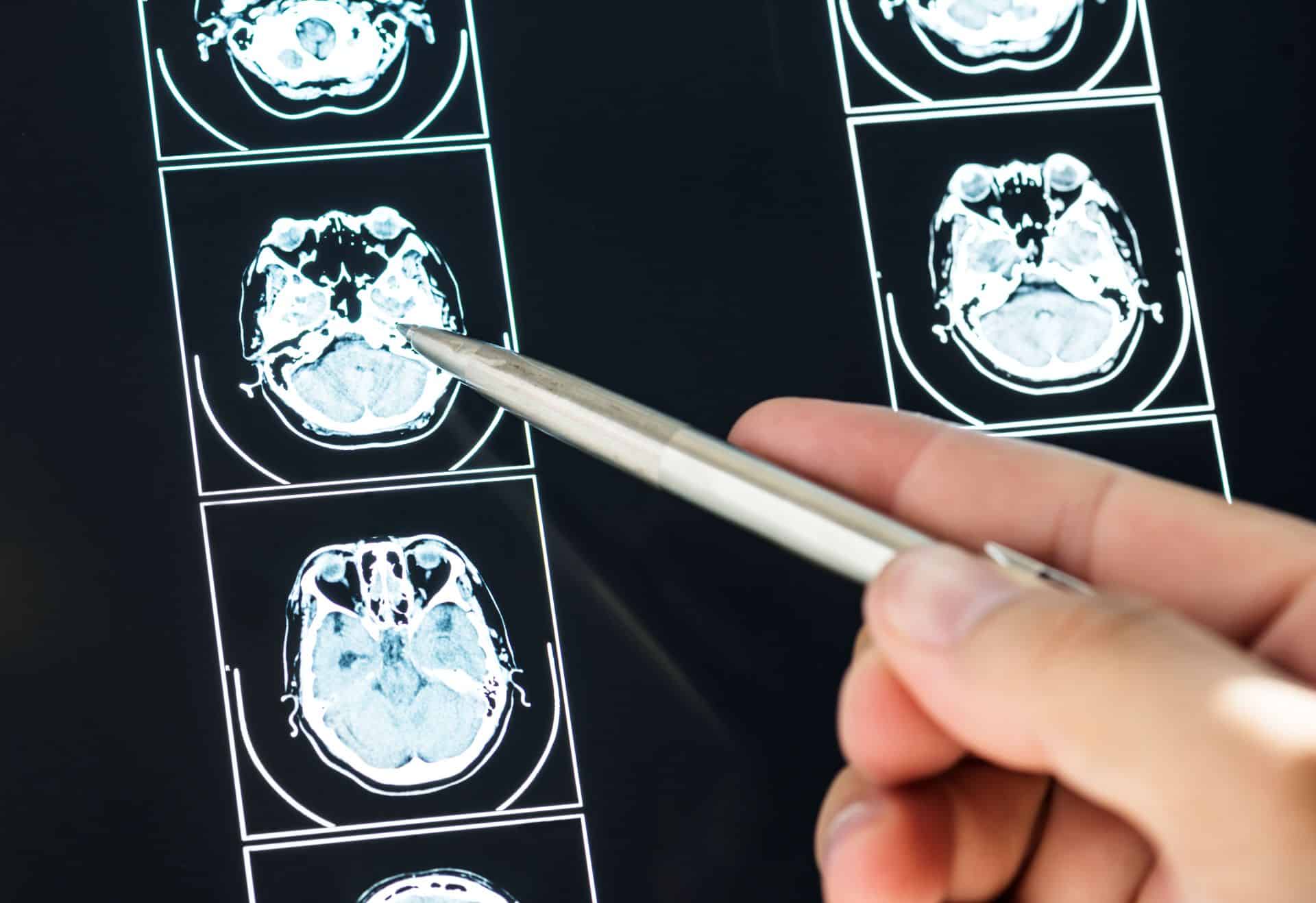 Close-up of brain CT scan images being reviewed by a medical professional, highlighting traumatic brain injury diagnosis after a serious accident.